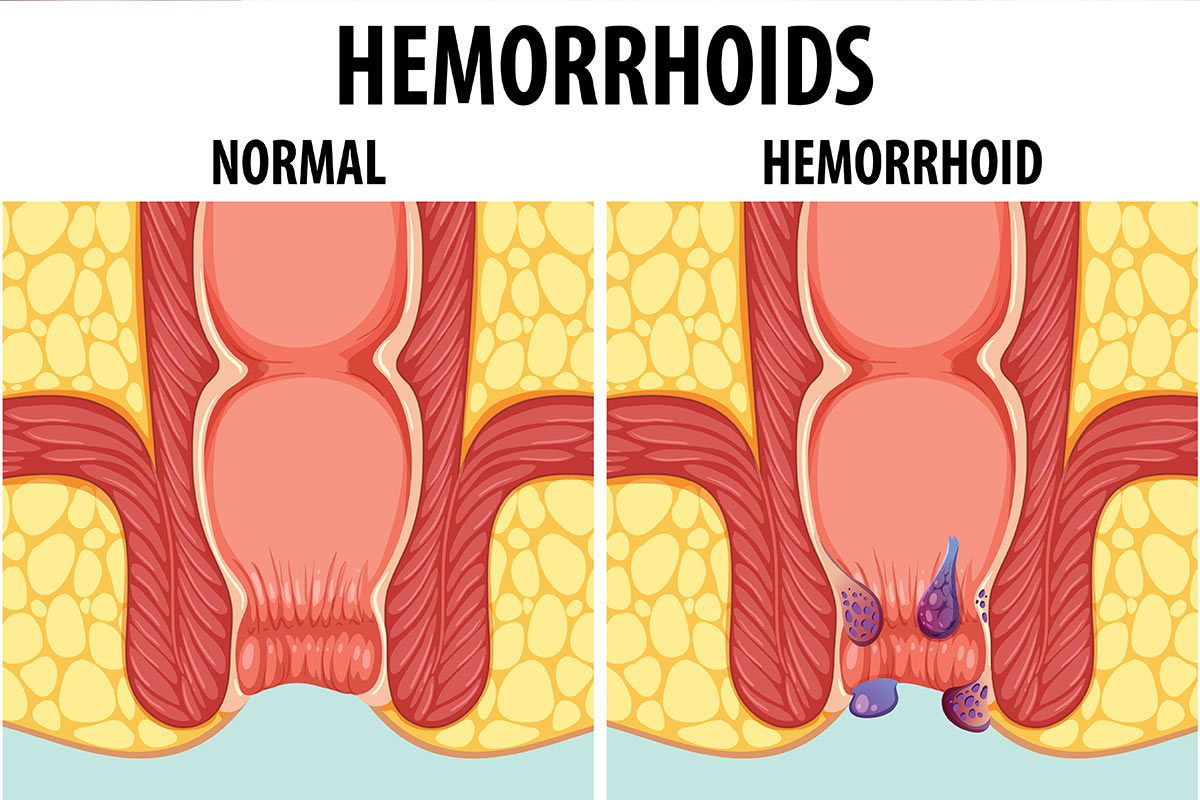 Piles-or-hemorrhoids-.jpg