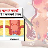 मूळव्याध - Piles Treatment