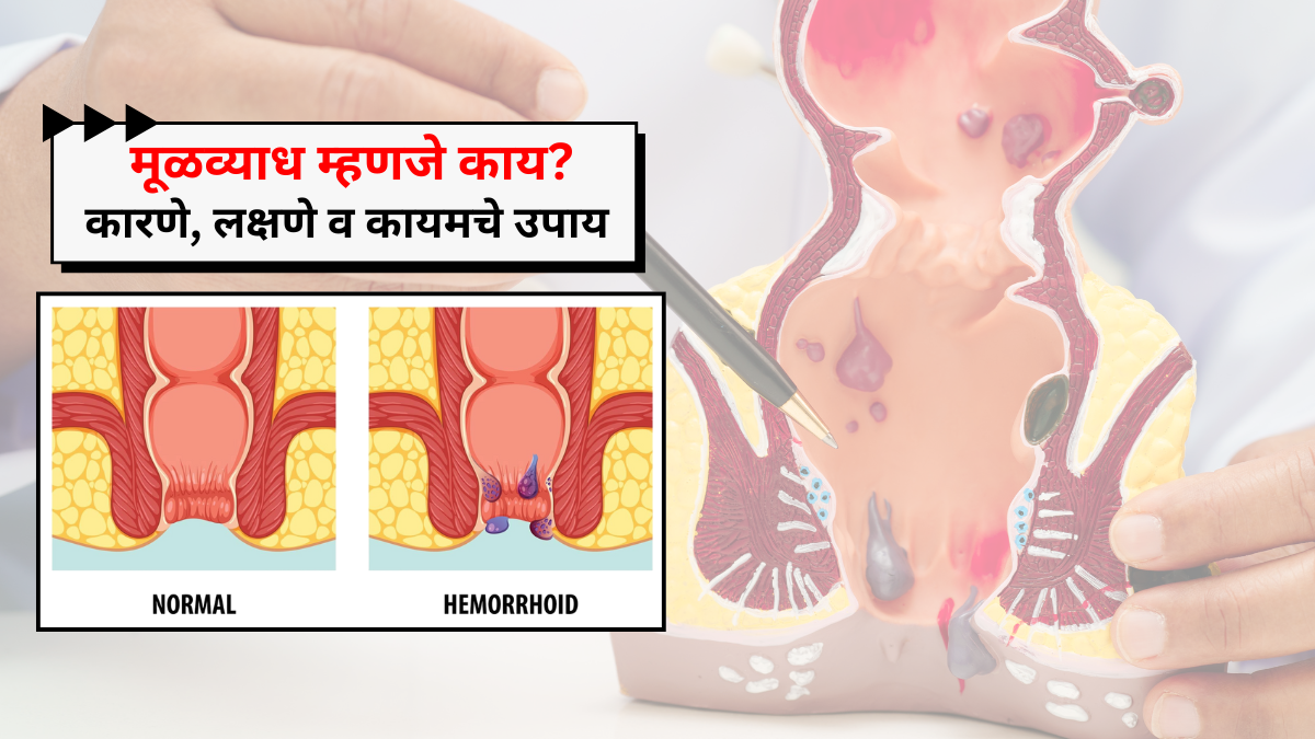 मूळव्याध-म्हणजे-काय-कारणे-लक्षणे-व-कायमचे-उपाय.png