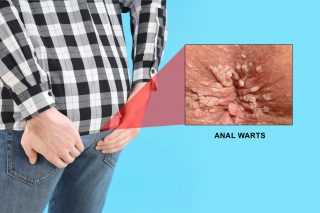 anal warts