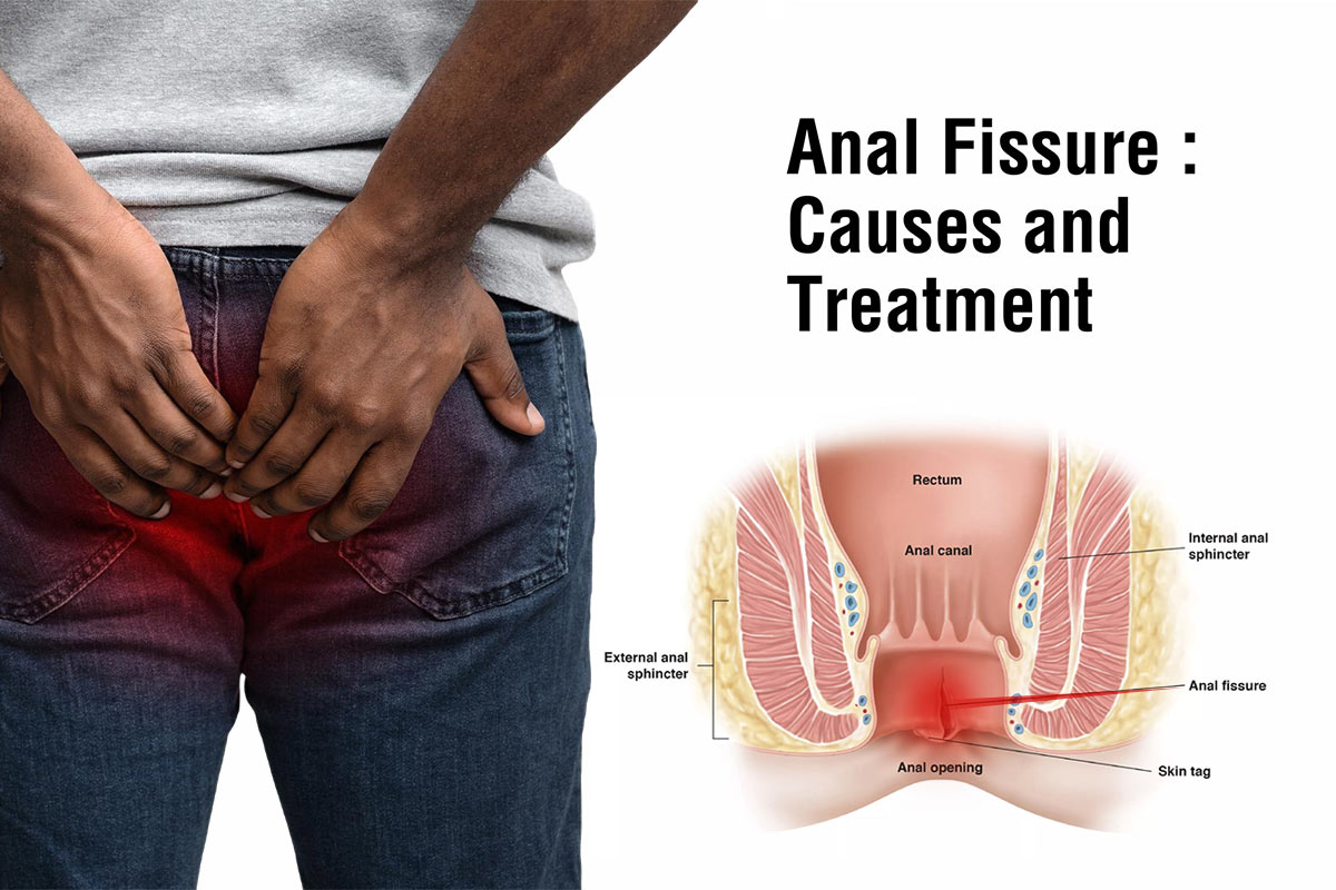 annular-fissure-treatment.jpg